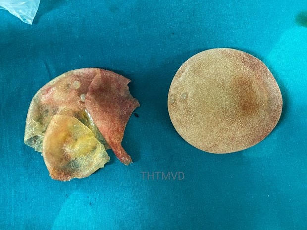 Túi ngực vỡ của bệnh nhân được lấy ra khỏi cơ thể. (Ảnh: PV/Vietnam+).