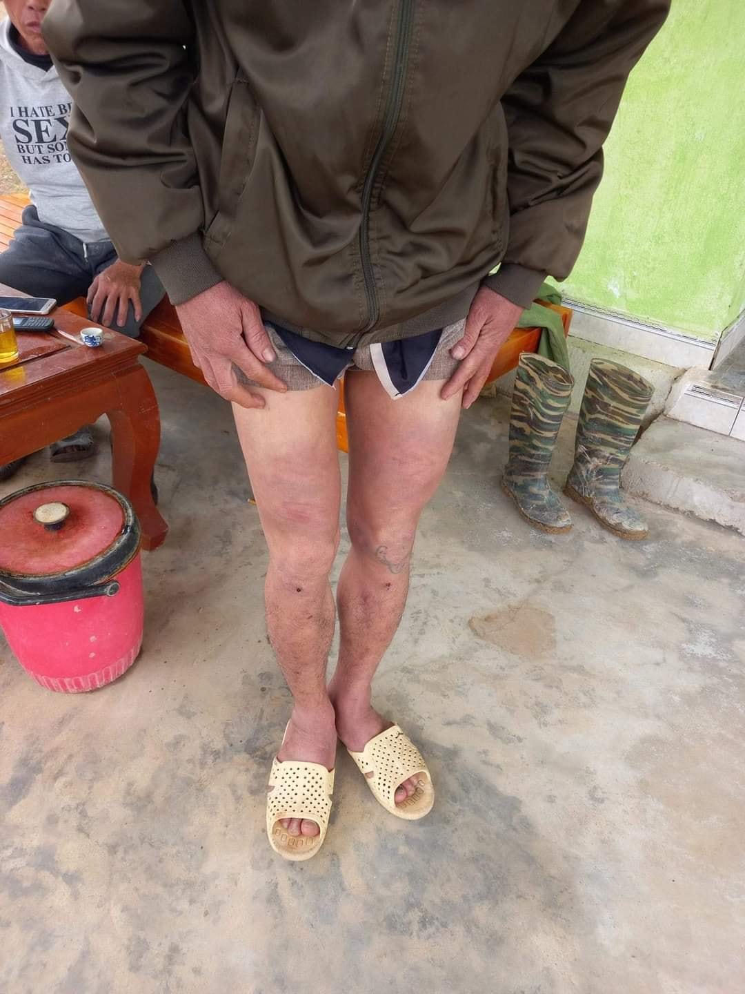 Người thân anh Bang "tố" những vết thương này do công an viên và dân quân xóm đánh.