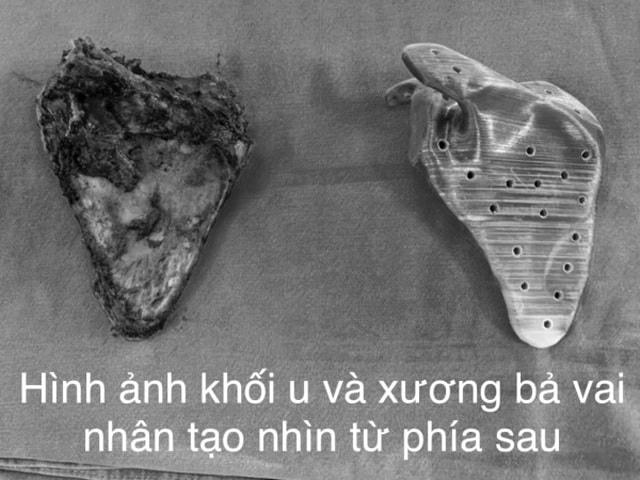 Bé trai 12 tuổi phát hiện mắc ung thư chỉ từ cơn đau âm ỉ ở vai
