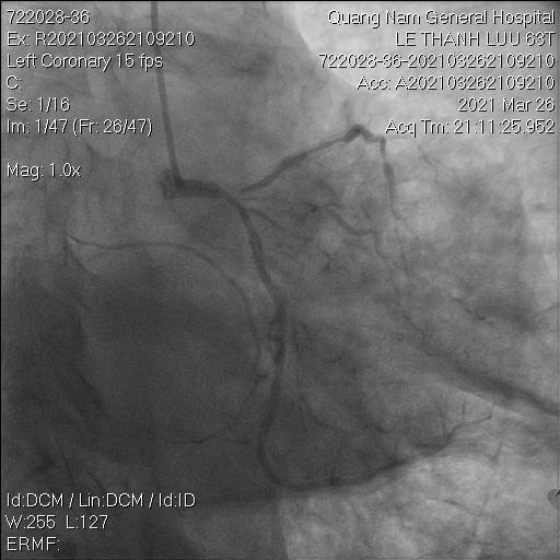 Hình ảnh bị tắc stent trước khi can thiệp.