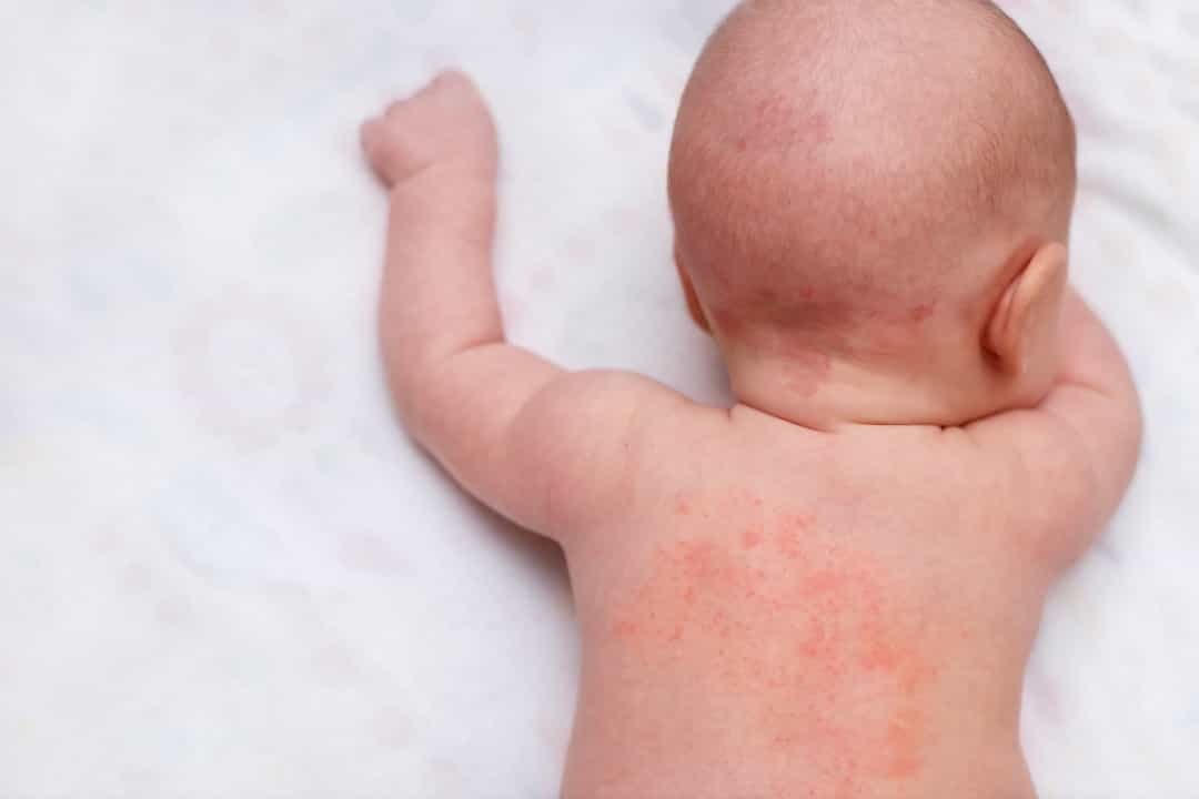 Phát ban - Nên kiểm tra các vết phát ban đang lan rộng hoặc tổn thương. Nếu trẻ bị phát ban gây đau, đó thường là dấu hiệu của nhiễm trùng. Ví dụ, các bệnh như thủy đậu và bệnh zona có thể gây ra các triệu chứng này.
