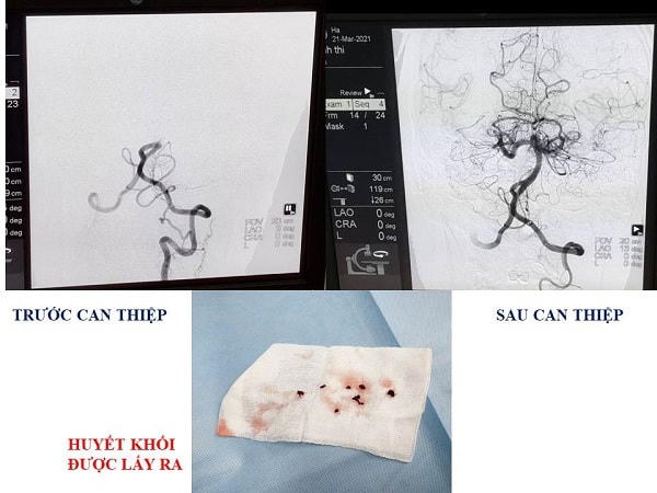 Hình ảnh chụp số hóa và huyết khối sau khi phẫu thuật.