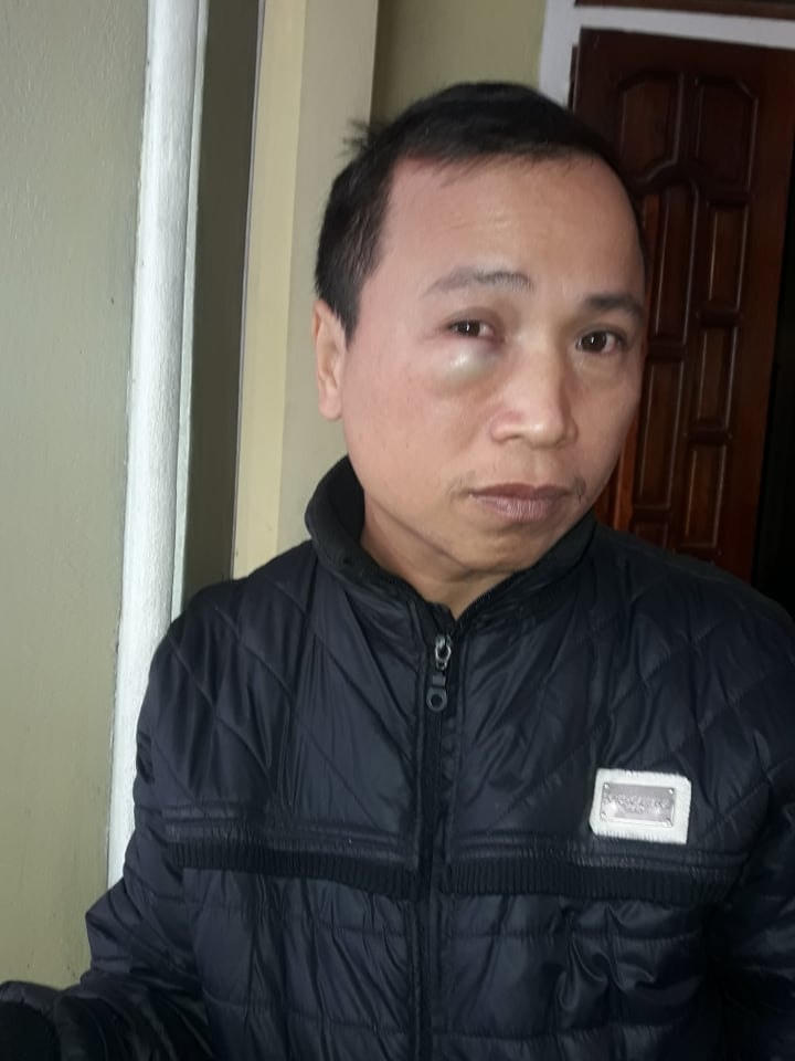Mắt phải của anh Sơn bị ông Đượi đấm sưng tấy.