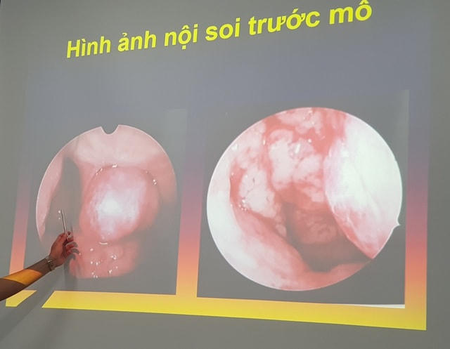 Khối u như một bể máu, gây tắc hoàn toàn lỗ mũi của bệnh nhi trên hình ảnh nội soi.  