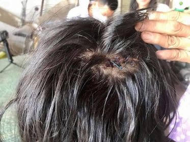 Vết thương trên đầu bé V.