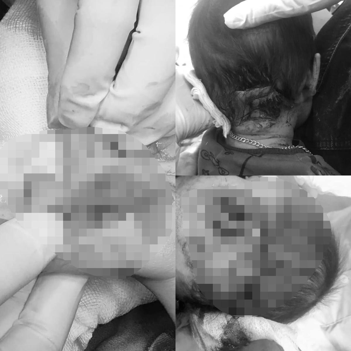 Hình ảnh vết thương mà 2 cháu nhỏ bị chó dữ tấn công (Ảnh: Bệnh viện cung cấp).
