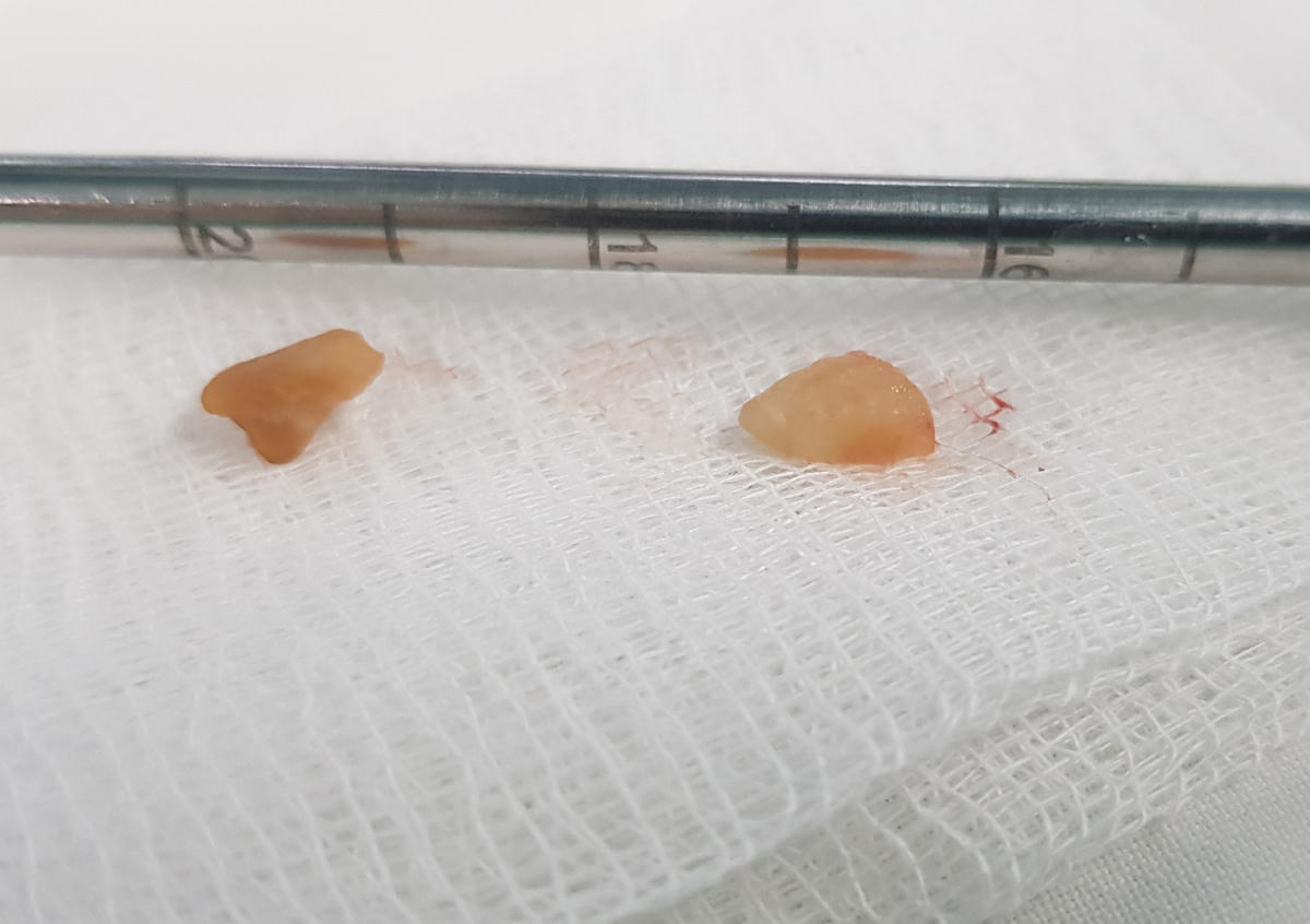 Hai mảnh đậu phộng được lấy ra từ phế quản gốc 2 bên của cháu bé.
