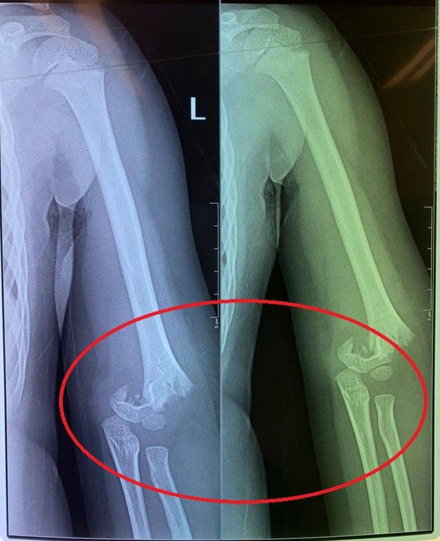 Con chị H. bị gãy phần khuỷu tay.