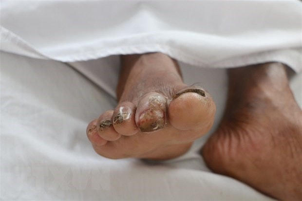 Quảng Trị: 4 trường hợp tử vong có liên quan đến bệnh Whitmore