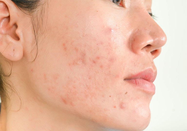 Rau kinh giới có thể giúp giảm mụn, làm trắng da.