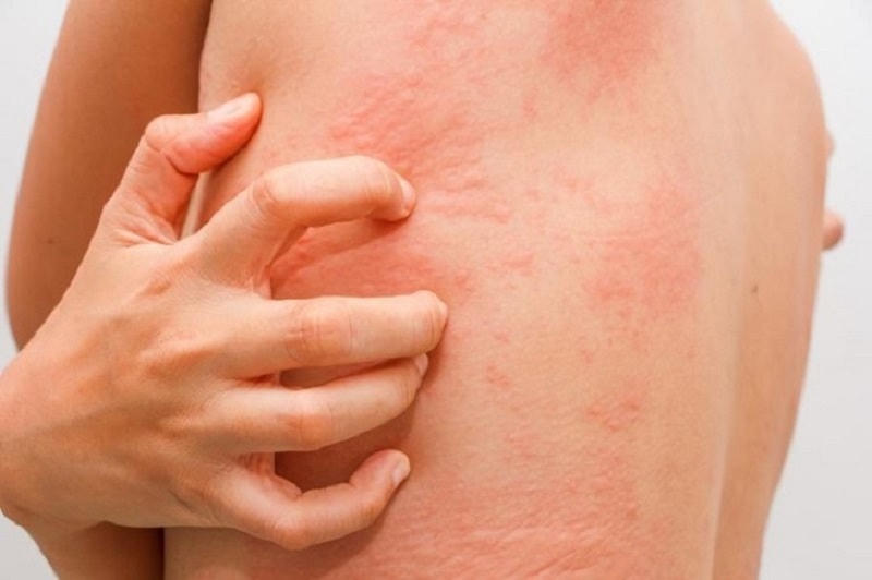 Người bị dị ứng có biểu hiện da ửng đỏ xuất hiện kèm theo ngứa dai dẳng, có dấu hiệu mề đay trên da.
