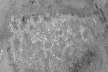 Vết tổn thương bỏng do vôi gây ra trên cơ thể người. 