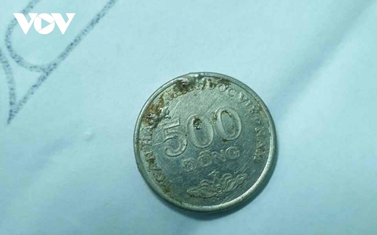 Dị vật đồng xu được gắp ra thành công.  