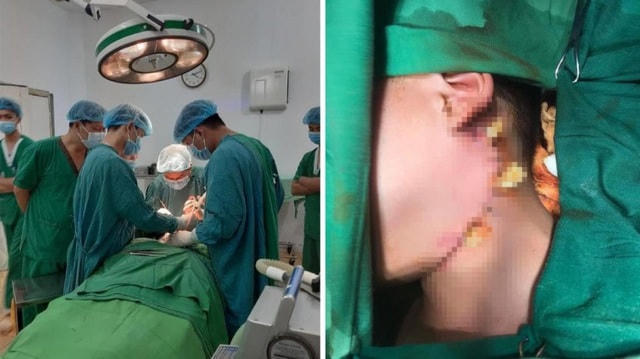 Cháu bé bị cành cây xuyên trúng cổ may mắn được cứu sống. (Ảnh: Bệnh viện cung cấp).