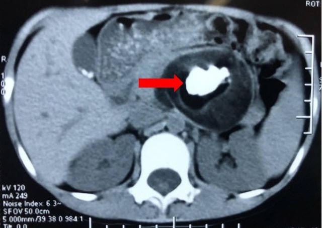 Khối u quái nằm sau phúc mạc của trẻ có đường kính 8 cm.