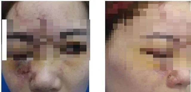 Lĩnh hậu quả vì tiêm chất làm đầy (filler) tại các cơ sở không đảm bảo