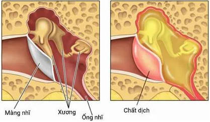 Trẻ có thể bị viêm tai giữa nếu như cha mẹ không rửa mũi đúng cách. (Ảnh minh hoạ).