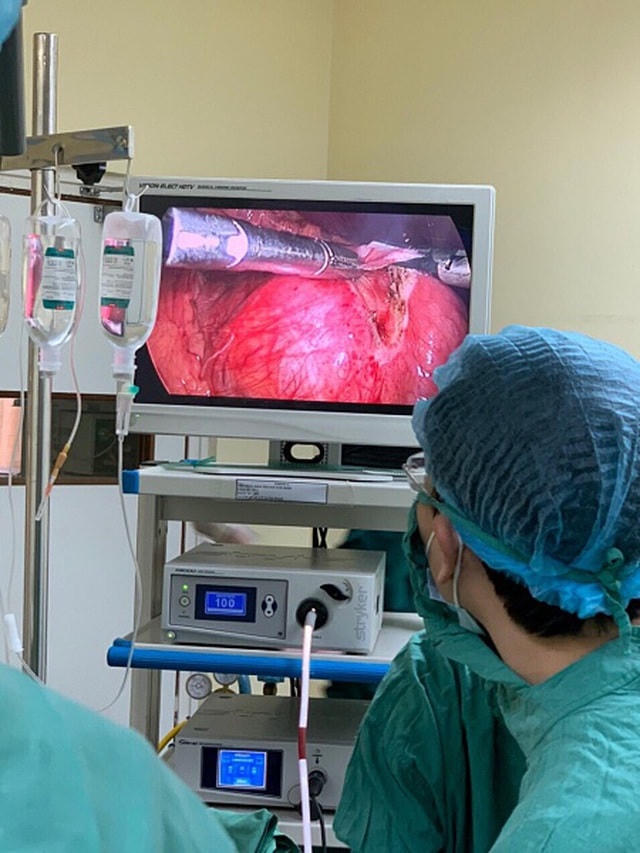 Các bác sĩ phẫu thuật loại bỏ khối u quái bằng nội soi.