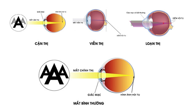 Cách phòng bệnh và chăm sóc đôi mắt