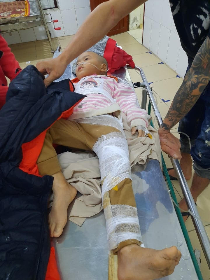 Cháu trai 5 tuổi bị gãy xương đùi.