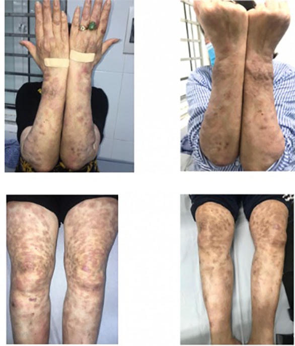 Bệnh nhân điều trị phong tại BV Da liễu trung ương.