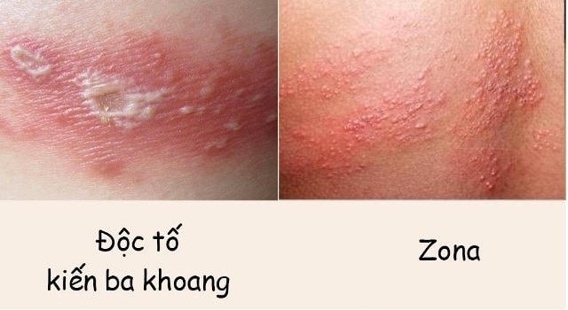 Sự khác nhau giữa viêm da do tiếp xúc kiến ba khoang và bệnh Zona.