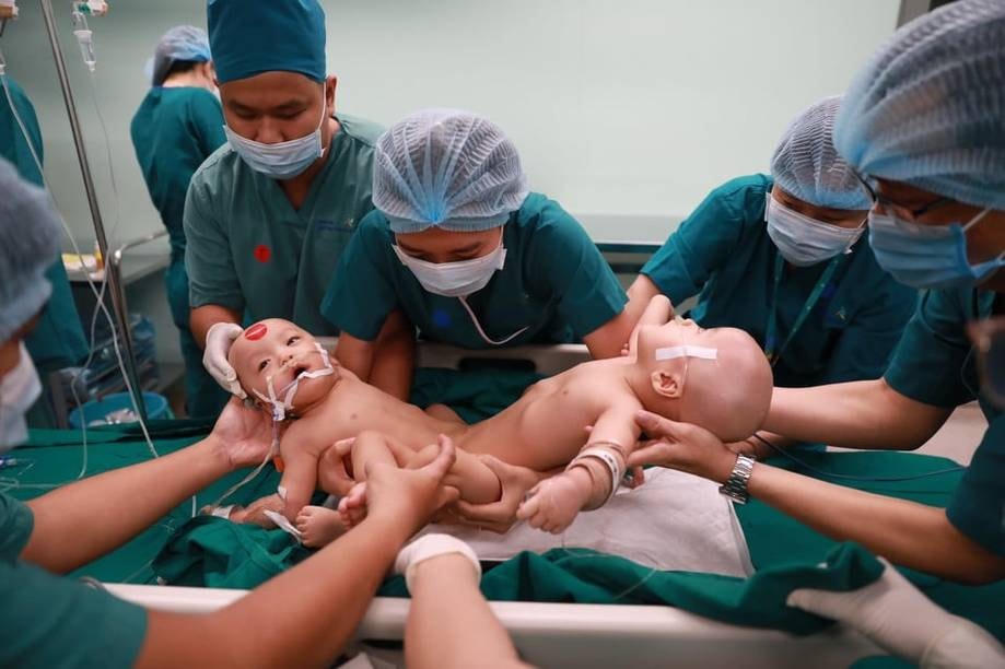 Hai bé Trúc Nhi - Diệu Nhi được tiến hành phẫu thuật tách rời thành công. Ảnh: Hữu Khoa.