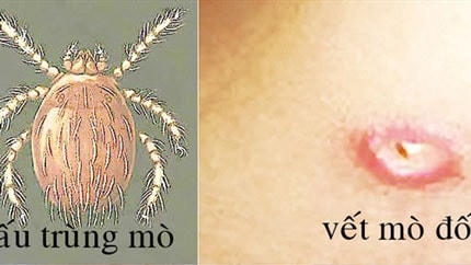 Chỗ mò đốt thường có vết loét.