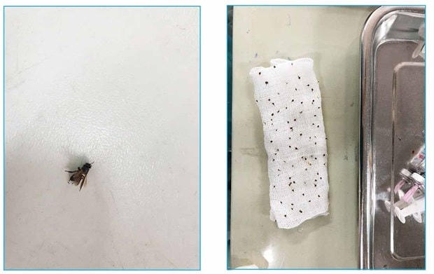 Nọc độc của ong được lấy từ da của người bệnh. Ảnh: BVCC.