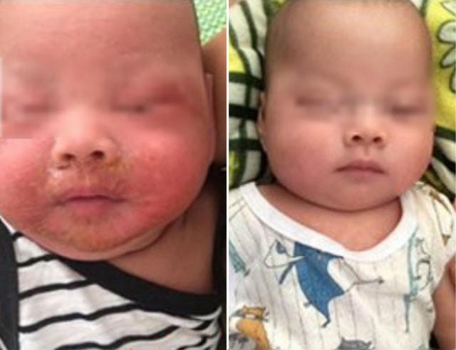 Bé 4 tháng tuổi bị bong loét da mặt do tụ cầu trước và sau khi được điều trị bằng kháng sinh đặc hiệu. Ảnh: Bệnh viện cung cấp.