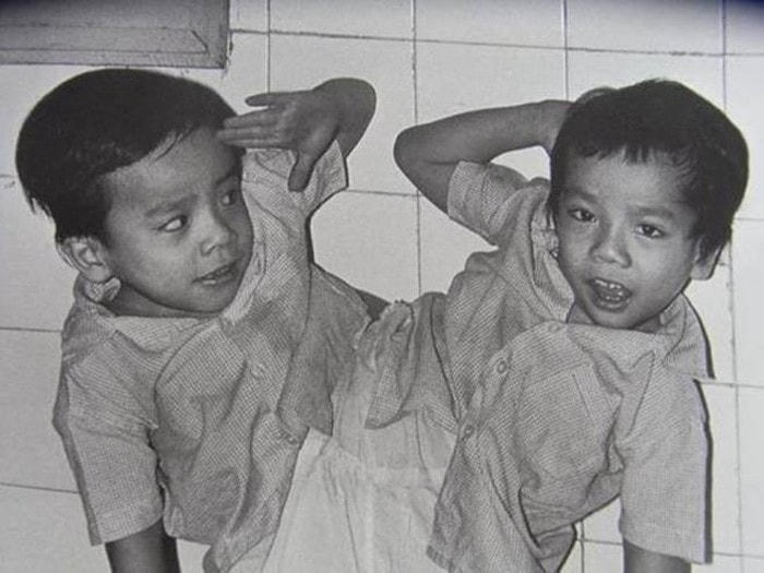Ca mổ tách cặp song sinh đầu tiên tại Việt Nam. Nguồn: Internet.