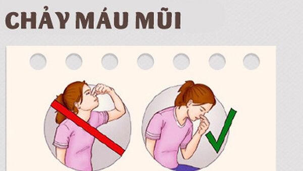 Vách ngăn mũi bị vẹo là một trong những nguyên nhân gây chảy máu cam ở trẻ.