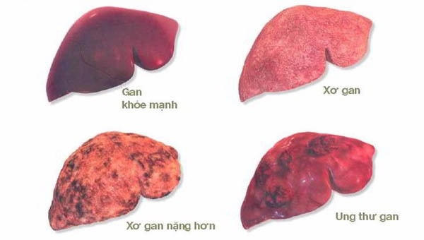 Đừng bỏ qua dấu hiệu của những bệnh ung thư thường gặp