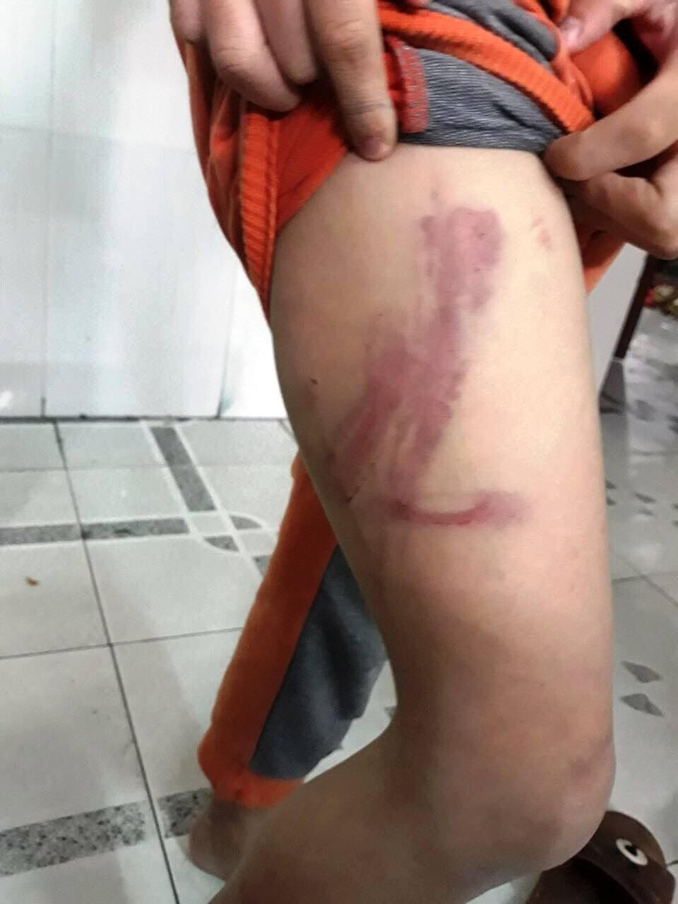 Trên người cháu N. xuất hiện nhiều vết bầm tím.