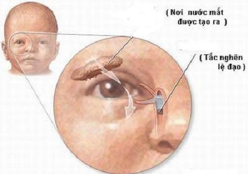 Trẻ sơ sinh bị tắc tuyến lệ, xử lý thế nào?