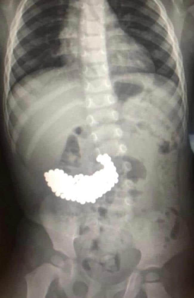 Hình ảnh X quang cho thấy hàng trăm viên bi nam châm trong đường tiêu hóa của bệnh nhi