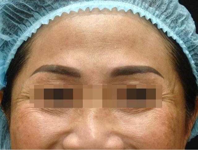 Nữ bệnh nhân trước và sau khi tiêm botulinum điều trị nhăn da trán tại Bệnh viện Da Liễu, TP HCM