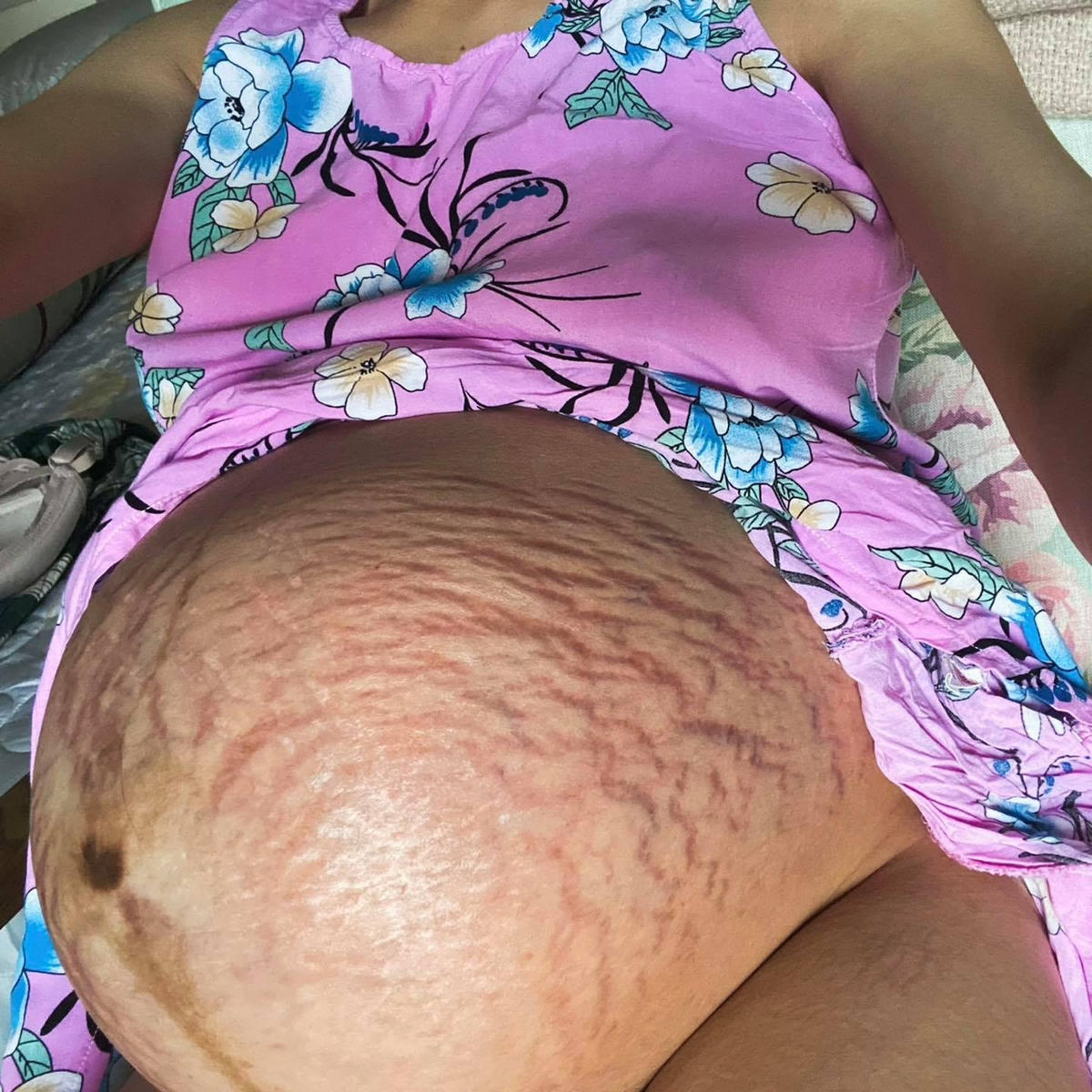 Trên trang Facebook cá nhân, nữ ca sĩ công khai đăng tải những bức hình rạn bụng sau sinh. Ảnh: FBNV