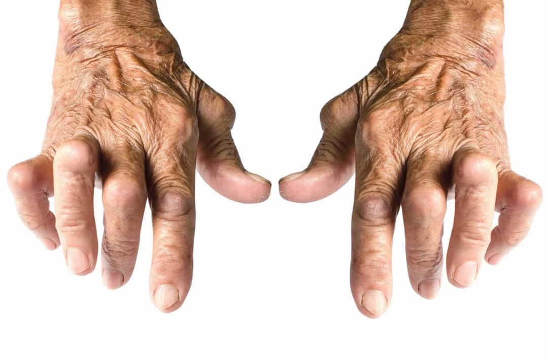Tác hại - Tiêu thụ sữa có thể làm trầm trọng thêm các triệu chứng viêm khớp, khô khớp, viêm phế quản và viêm mũi, theo một nghiên cứu của Đại học Campinas ở Brazil.