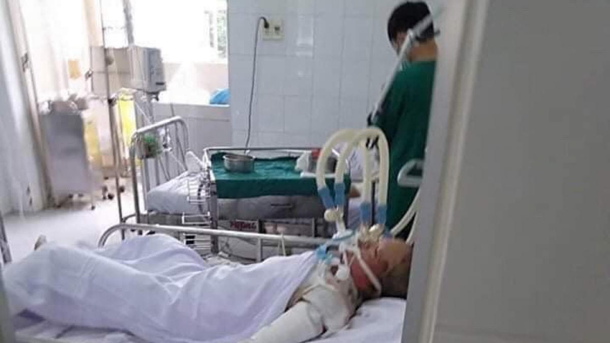 T. đang điều trị tại Bệnh viện Chợ Rẫy TP.HCM trong tình trạng bỏng nặng.