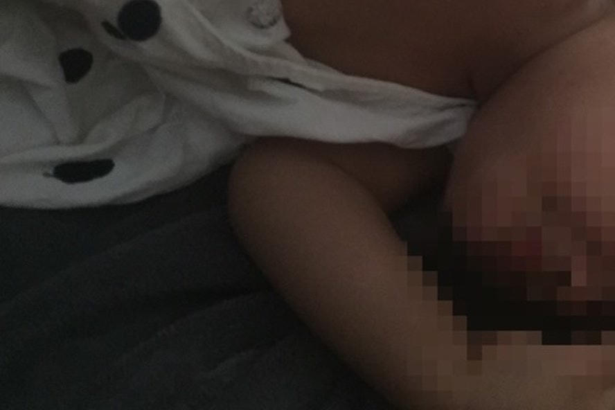 Những vết thương trên người bé gái được chị H. chụp lại.