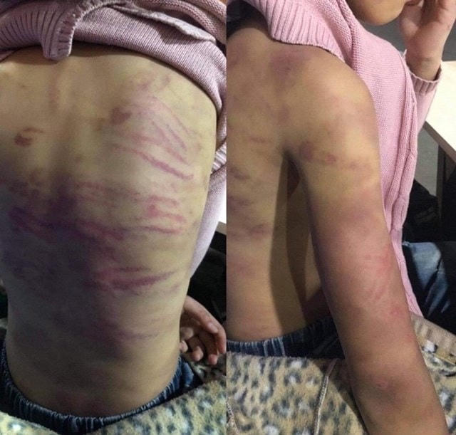 Bé gái  12 tuổi bị bạo hành dã man.