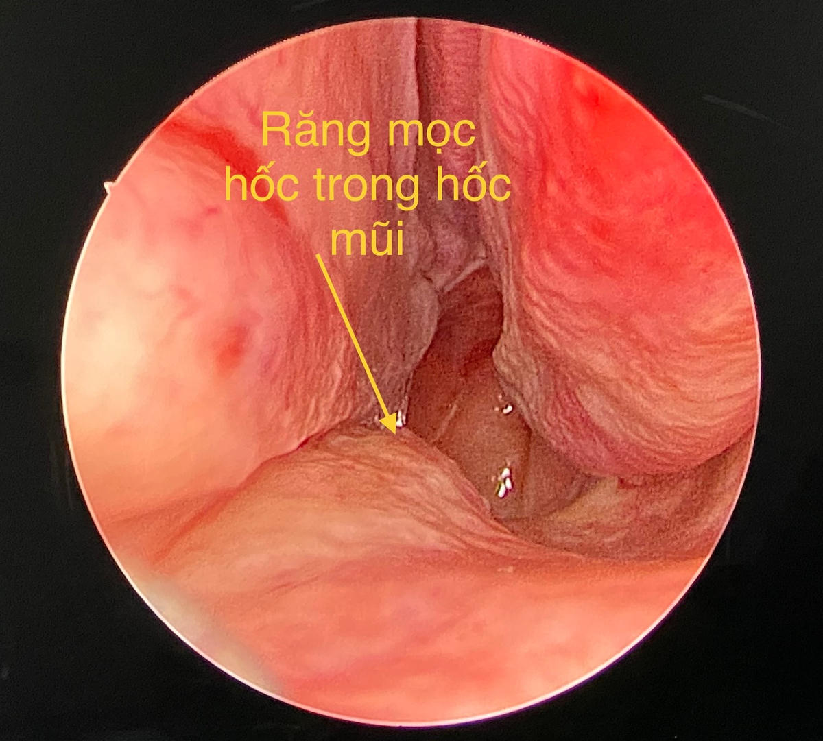 Clip dùng xẻng đào chiếc răng mọc lạc chỗ trong khoang mũi bệnh nhân