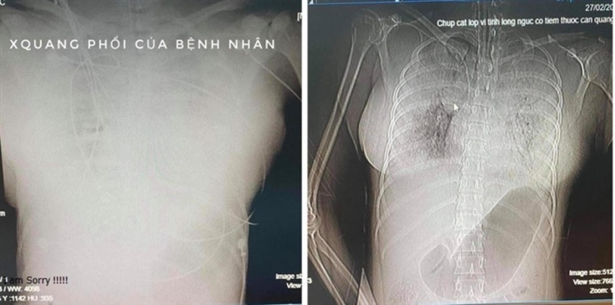 Hình chụp CT có thuốc cản quang cho thấy có nhiều ổ xuất huyết lớn.  
