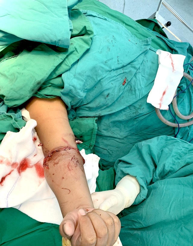 Bác sĩ đã thực hiện cuộc phẫu thuật nối thành công chi thể cho bệnh nhi.