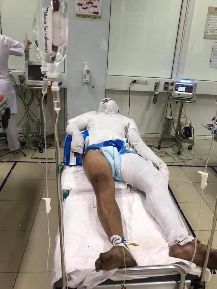 Anh S. hiện đang điều trị tại BV Bỏng quốc gia.