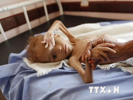 Trẻ em bị suy dinh dưỡng điều trị tại bệnh viện ở tỉnh Hajjah, Yemen. (Ảnh: THX/TTXVN).