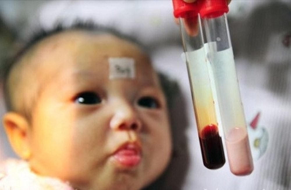 Những em bé sinh ra mắc bệnh tan máu bẩm sinh phải điều trị hết sức vất vả. (Ảnh mang tính minh họa).