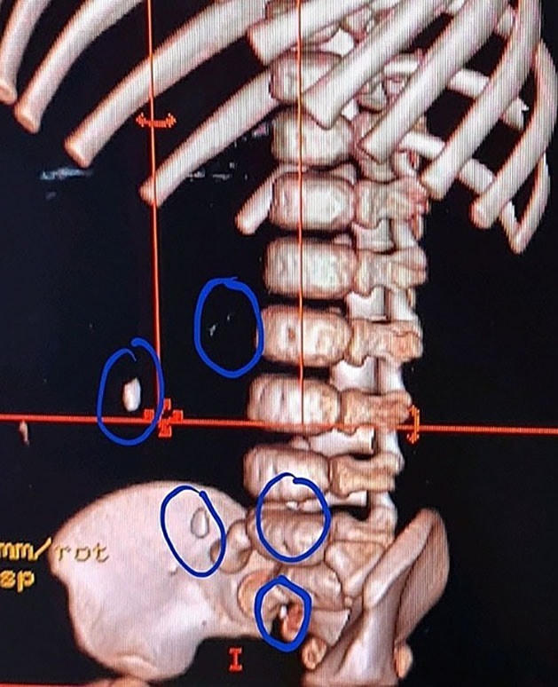CT scan ngực bụng dựng hình cho thấy hình ảnh các mảnh kim loại rải rác. Ảnh do bệnh viện cung cấp.  