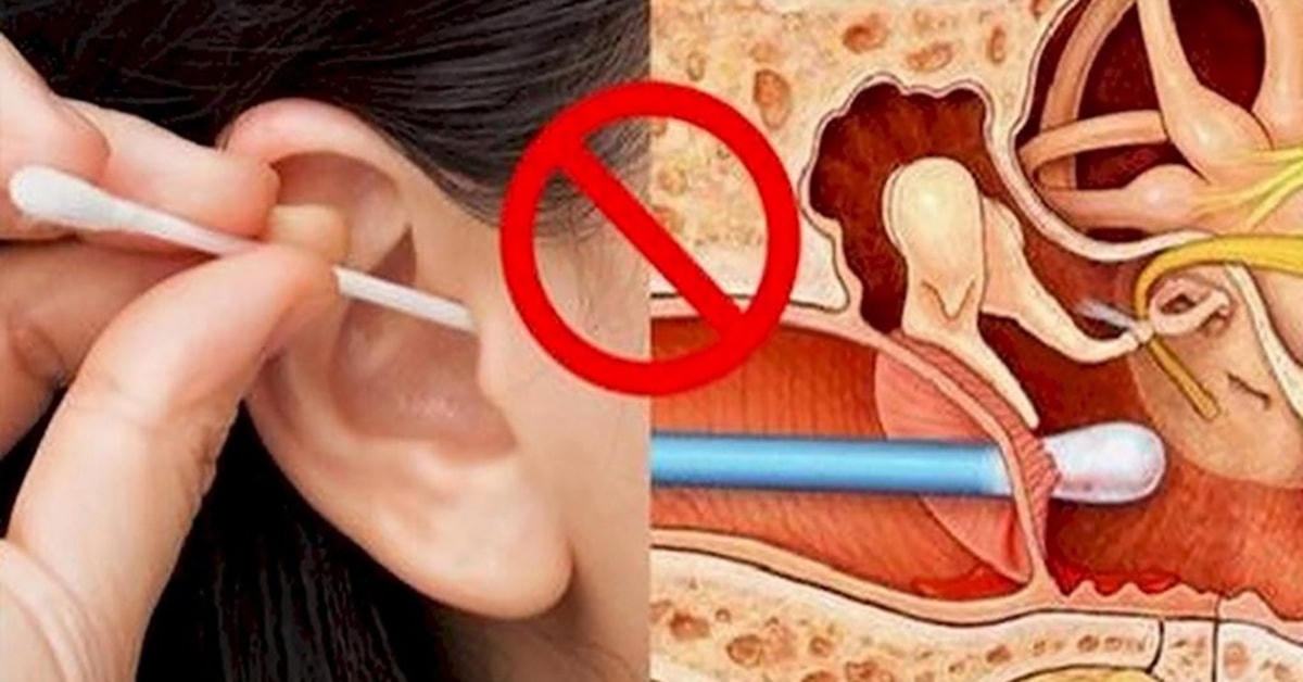 Ngoáy tai không đúng có thể làm thủng màng nhĩ.